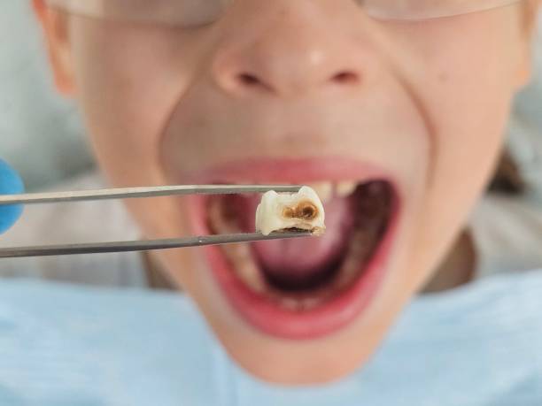 Best Emergency Dental Care for Abscessed Tooth in Glassmanor, MD